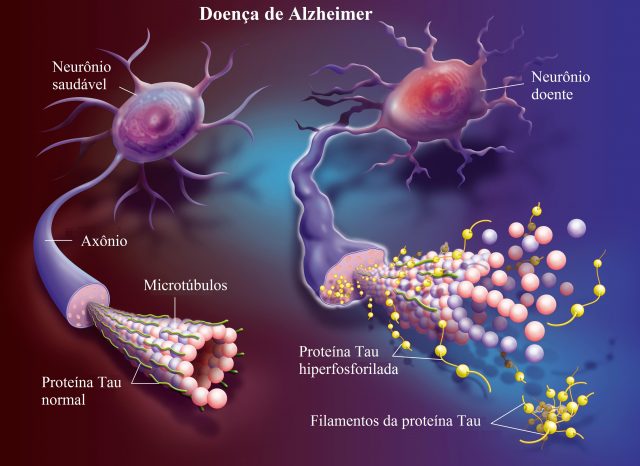 Imagem explicativa sobre a degeneração dos neurônios